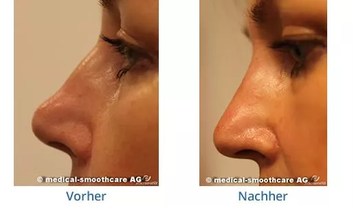 Nasenkorrektur ohne OP